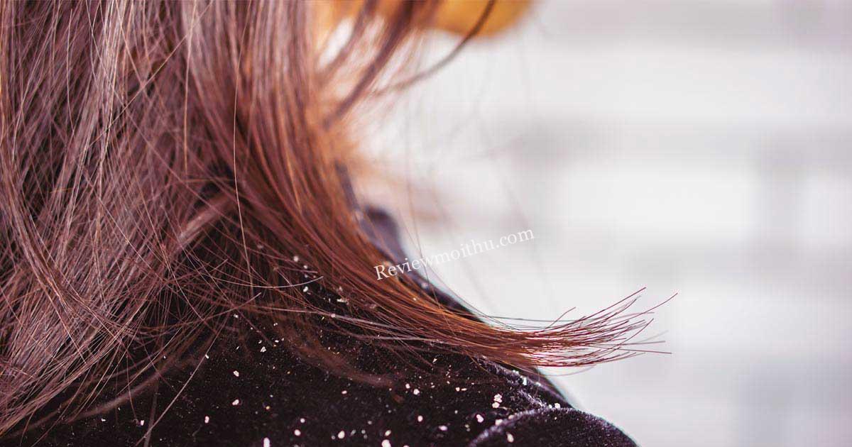 Tiết lộ cách trị gàu cho tóc nhuộm hiệu quả  có thể bạn chưa biết