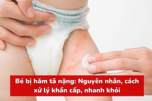 Chữa dị ứng bỉm cho trẻ sơ sinh bằng phương pháp dân gian